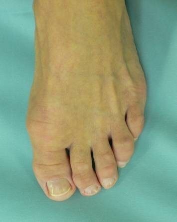 Hallux rigidus