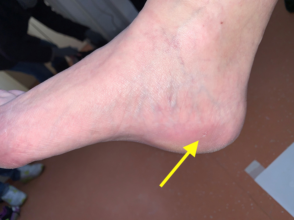 MIS Heel Spur Removal | Keyhole Foot Surgery Australia