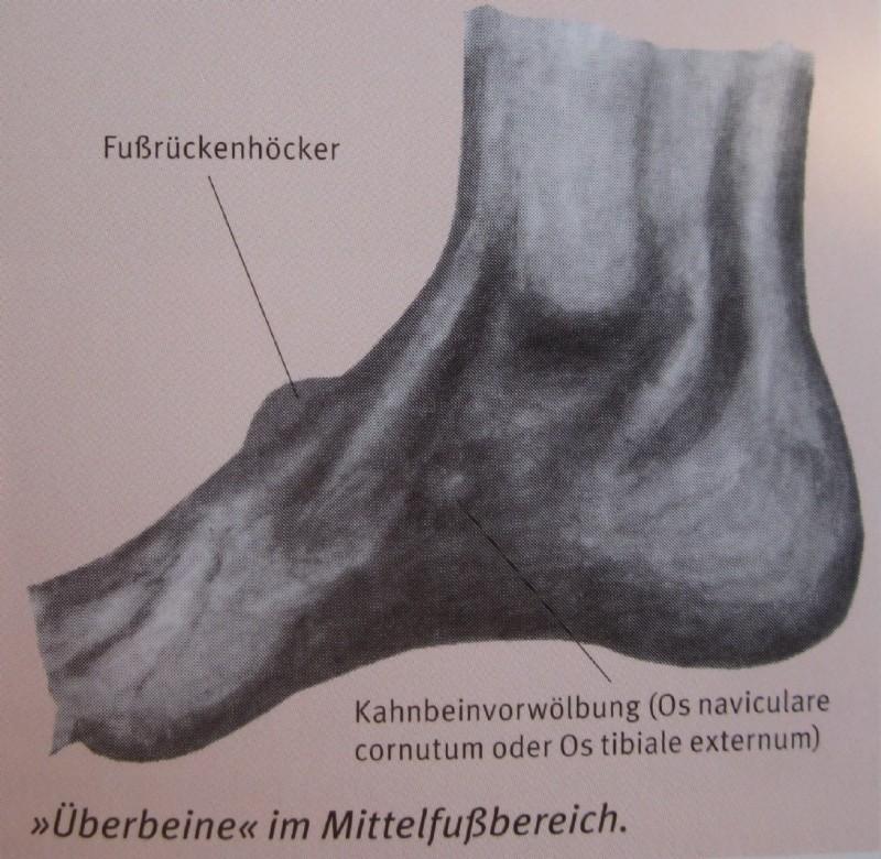 Zeichnung Überbeine 