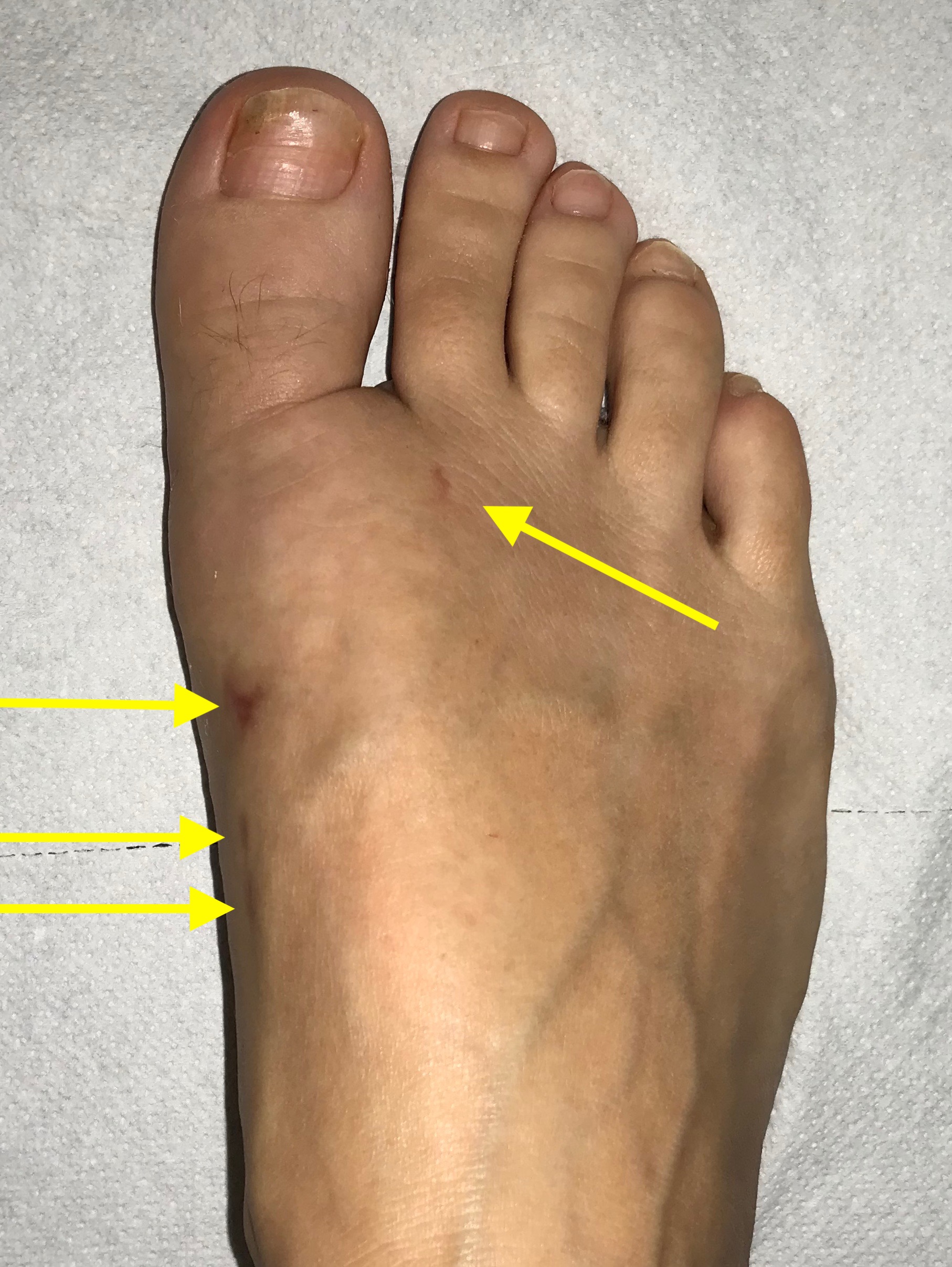 Wir führen die Hallux valgus OP minimalinvasiv durch