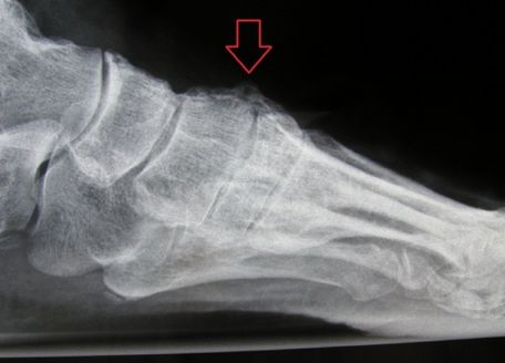 Röntgenaufnahme Fußgeschwulst
