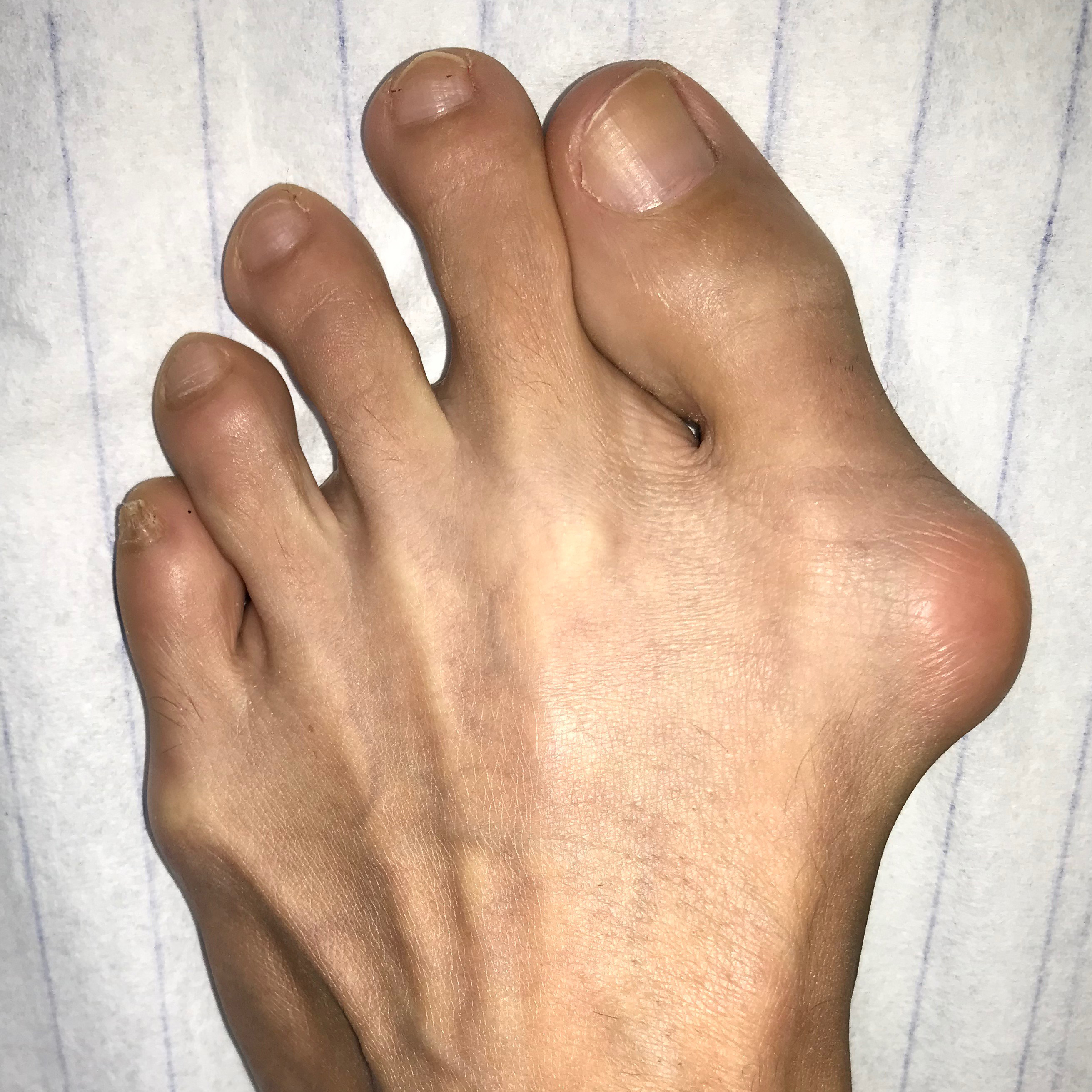 Wir führen die Hallux valgus OP minimalinvasiv durch