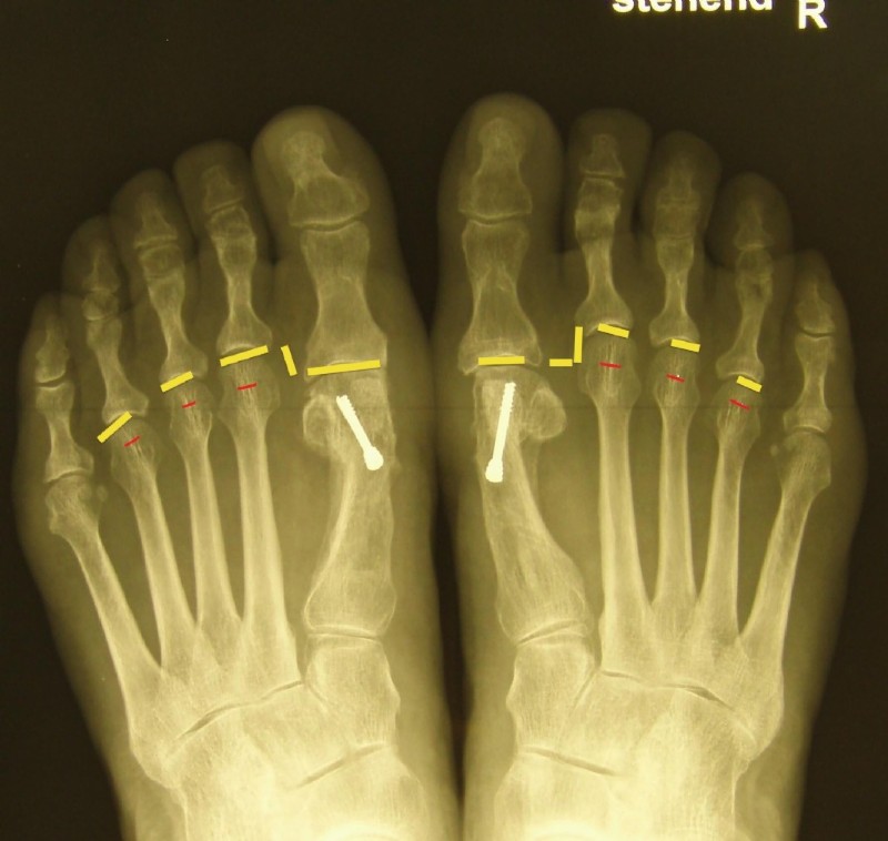 Spreizfuß Röntgenaufnahme