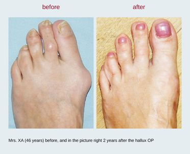 Hallux Valgus Operation, Hallux operieren 