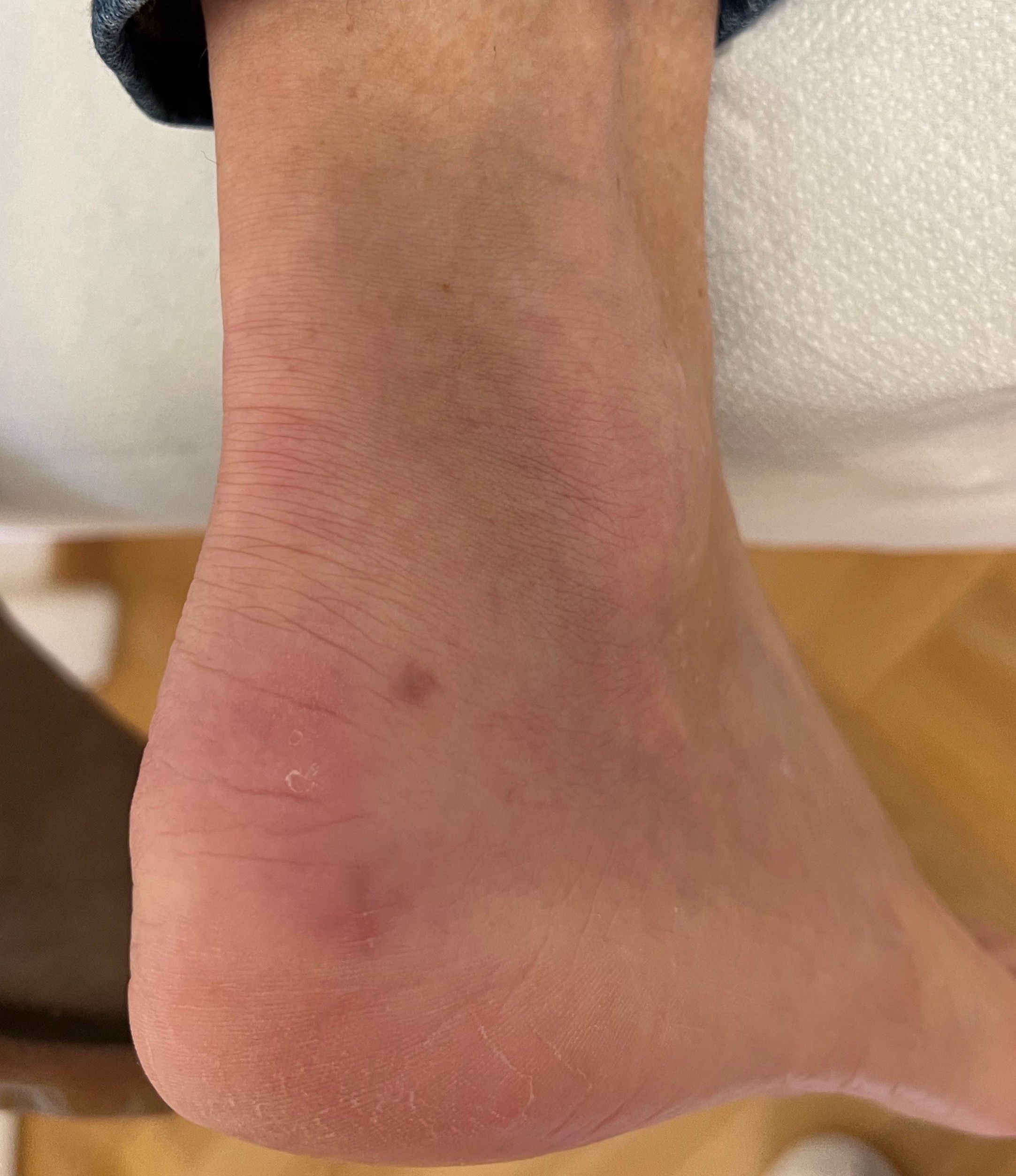 Sesamoid Foot Injury & Treatment | The Foot Practice Singapore
